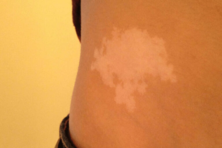 White Birthmark Meaning: 9 Spiritual Meanings